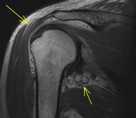 Figure 5 for case Axillary cyst and denervation